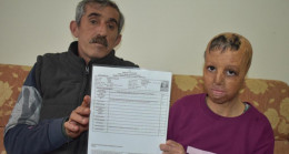 Suriye’de bomba düşen evlerinde yüzü yanan Evin, 10 yılda 109 ameliyat oldu