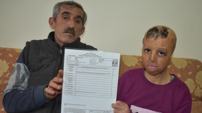Suriye’de bomba düşen evlerinde yüzü yanan Evin, 10 yılda 109 ameliyat oldu