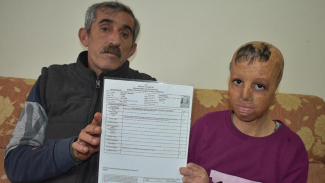 Suriye’de bomba düşen evlerinde yüzü yanan Evin, 10 yılda 109 ameliyat oldu