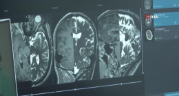 Epilepsi hastası şifayı Türkiye’de beyin pili ameliyatında buldu